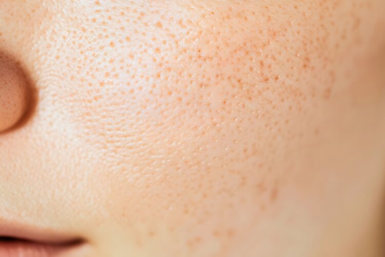 毛穴の悩み画像